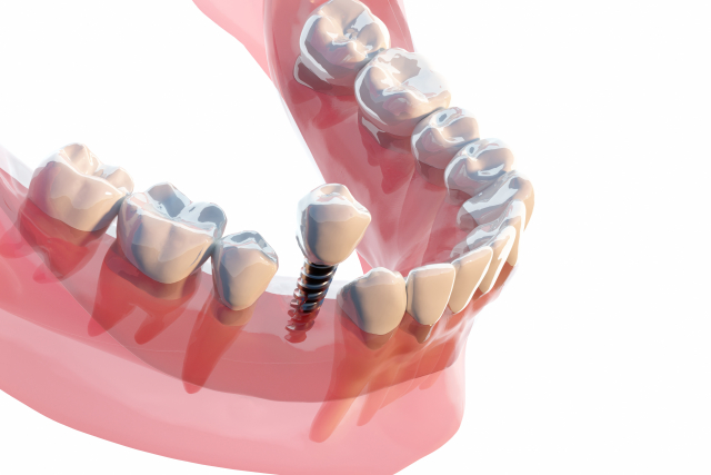 当院のインプラント治療